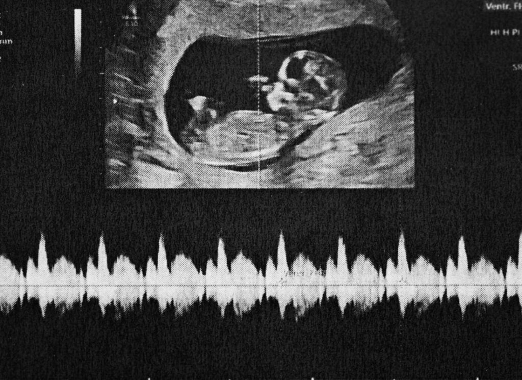 a ultrasound of a baby